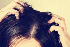 遗传性脱发怎么办 怎么解决？