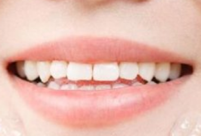 冷光美白牙齿的原理是什么？有什么特点？