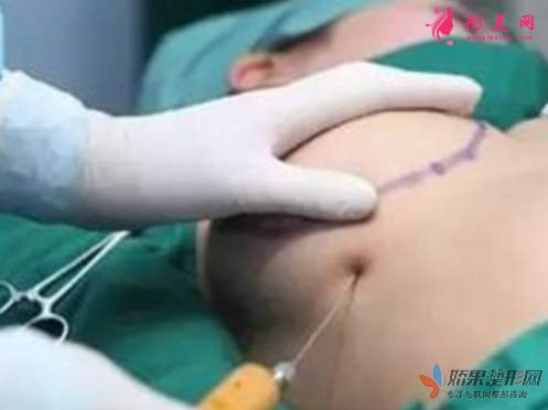 广州美莱隆胸手术多少钱
