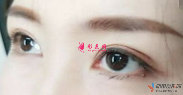 广州双眼皮手术需要多少钱