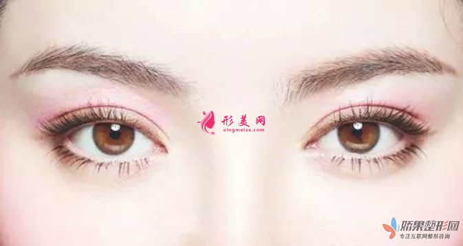 广州双眼皮手术需要多少钱