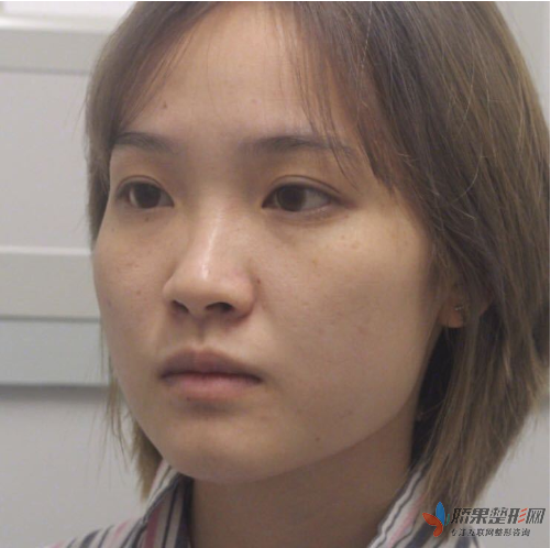 上海九院整形美容隆鼻哪个医生好?隆鼻案例分享！
