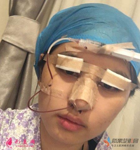 上海玫瑰医疗美容医院的眼部多项整形的案例