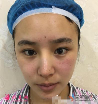 重庆西南医院整形科割双眼皮怎么样?亲身体验果分享