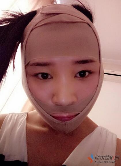 北京八大处张智勇V-line瓜子脸手术前后对比