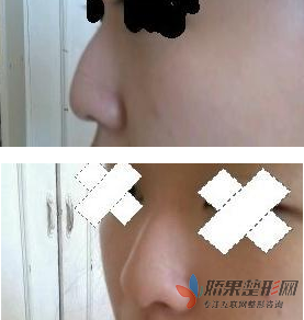驼峰鼻整形 提升个人气质杠杠的 - 珍美网