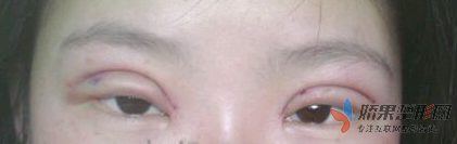 双眼皮手术  让我眼睛更加闪亮 - 珍美网