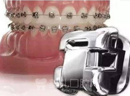 牙齿金属矫正能轻松改良龅牙，原来是这个原理！