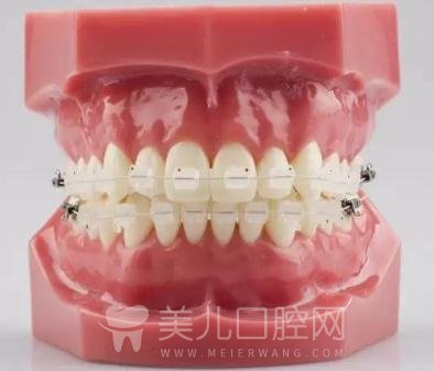牙齿金属矫正能轻松改良龅牙，原来是这个原理！